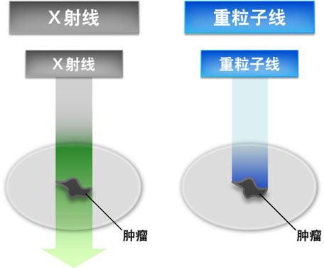 与传统放射线治疗不同的照射