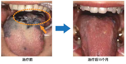 治疗成绩　头颈部肿瘤