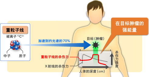 将重粒子加速到光速的70%后照射肿瘤病灶