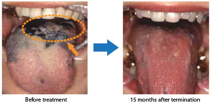 Treatment results: Head and neck cancer