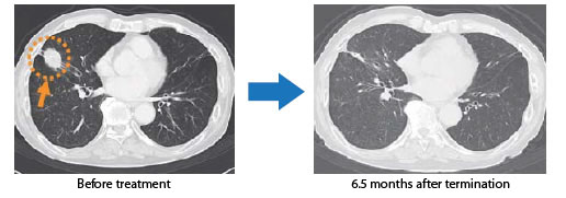 Treatment results: Lung cancer (non-small-cell lung cancer)