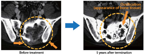 Treatment results: Bone and soft tissue tumors