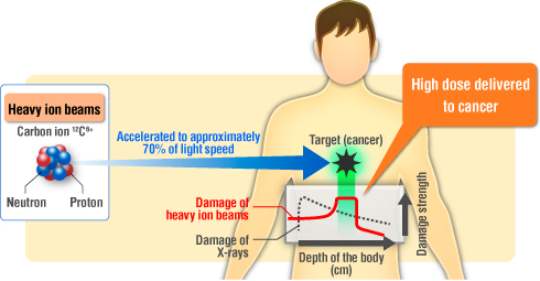 Heavy ions accelerated to 70% of light speed are delivered to cancer.