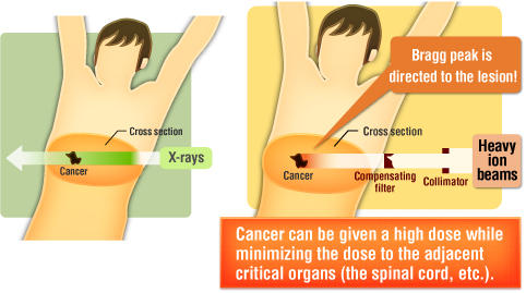 The target (cancer) can be externally irradiated with heavy ion beams, corresponding to any irregular shape of the target.