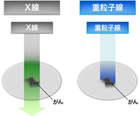 従来の放射線治療との照射の違い