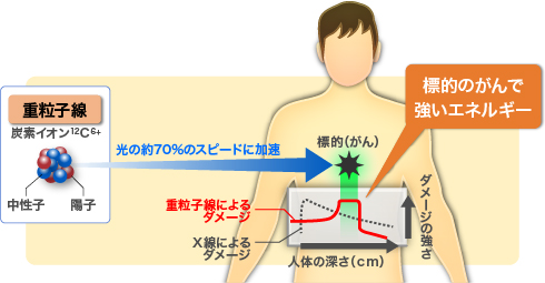 重粒子を光の速度の70%に加速してがん病巣を照射