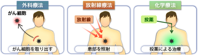 がん治療の3つの手法